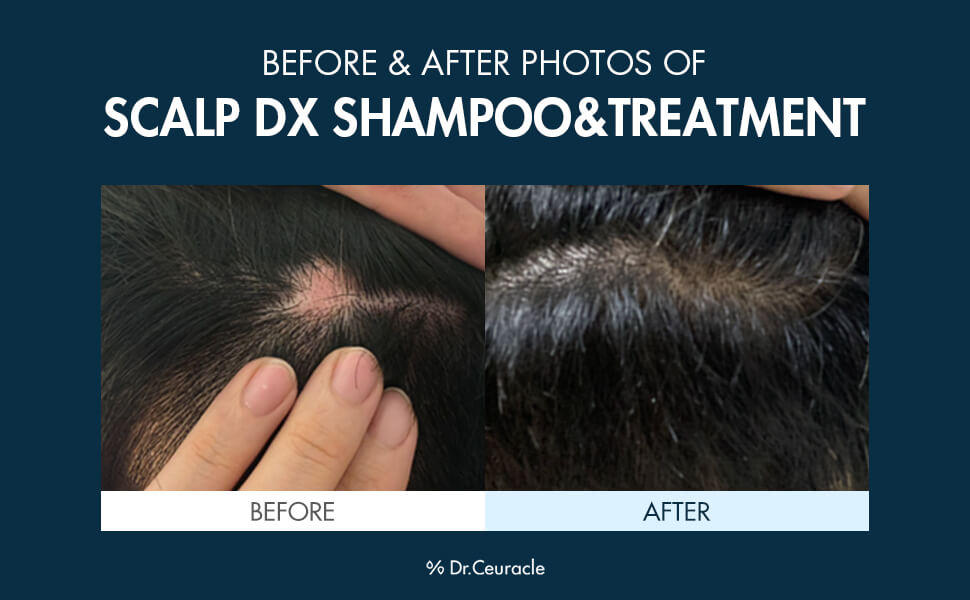 Scalp DX Scaling Shampoo [Dr.Ceuracle] (1)